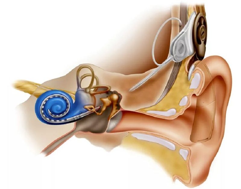 Магия звука для глухих. Что такое кохлеарная имплантация и кому она помогает?